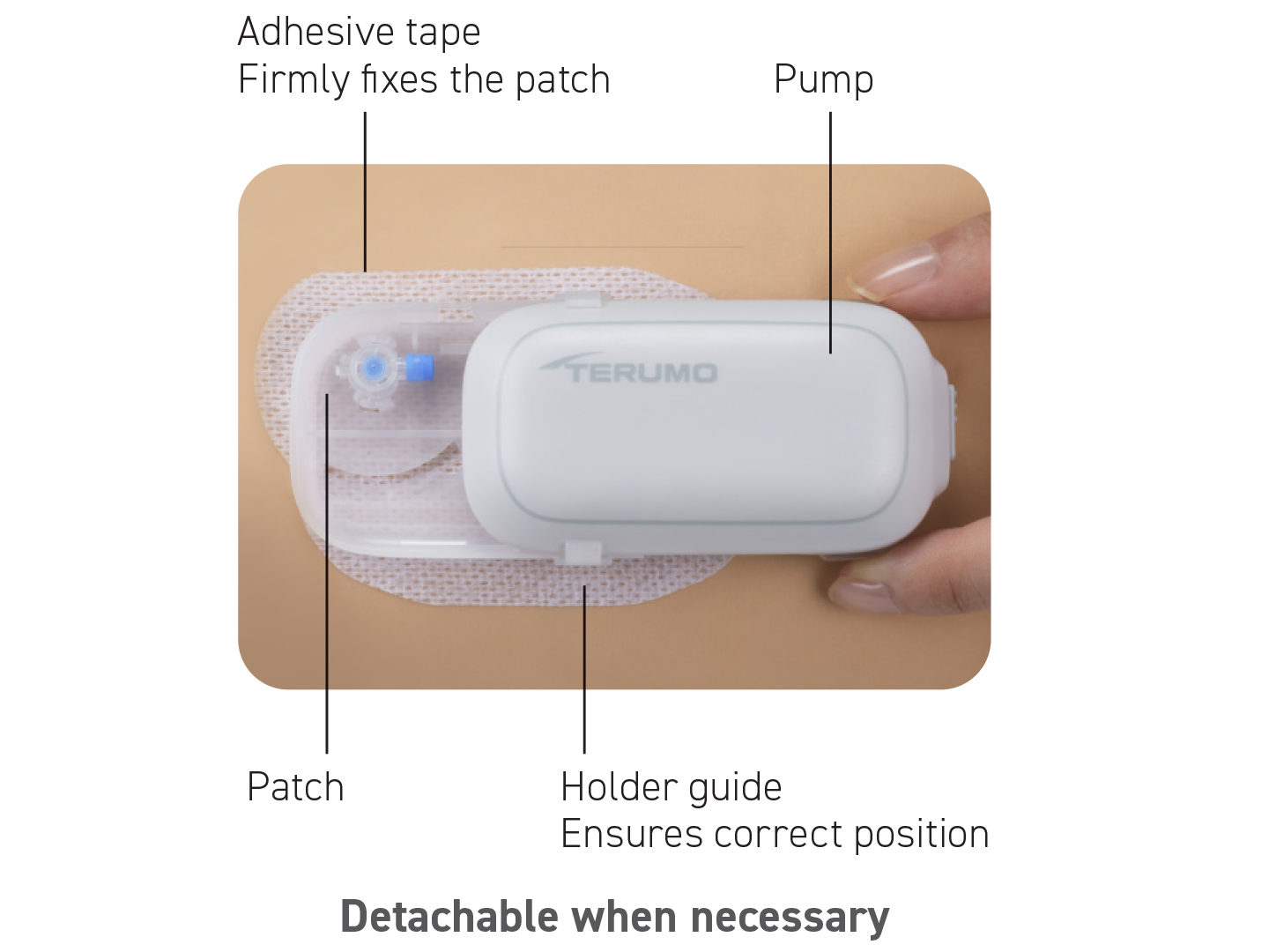 Medisafe WITH™ Detachable Insulin Patch Pump
